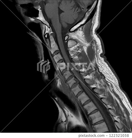 MRI of the cervical spine showing cervical myelopathy (cervical disc herniation, CDH) that causes neck pain and weakness 122321038