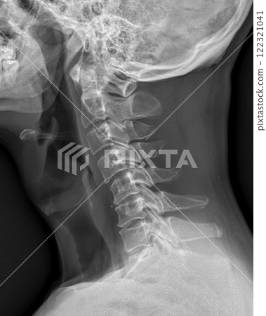 MRI of the cervical spine showing cervical myelopathy (cervical disc herniation, CDH) that causes neck pain and weakness MRI of the cervical spine showing cervical myelopathy (cervical disc herniation, CDH) that causes neck pain and weakness 122321041
