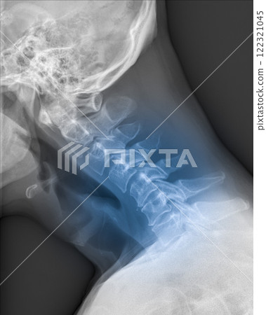 MRI of the cervical spine showing cervical myelopathy (cervical disc herniation, CDH) that causes neck pain and weakness MRI of the cervical spine showing cervical myelopathy (cervical disc herniation, CDH) that causes neck pain and weakness 122321045