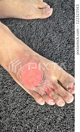 Second degree burns open wound, damage extends beyond the top layer of skin post blisters burst hick, soft, scab-like tissue called fibrinous exudate may develop over the wound Second degree burns open wound, damage extends beyond the top layer of skin post blisters burst hick, soft, scab-like tissue called fibrinous exudate may develop over the wound 122323563