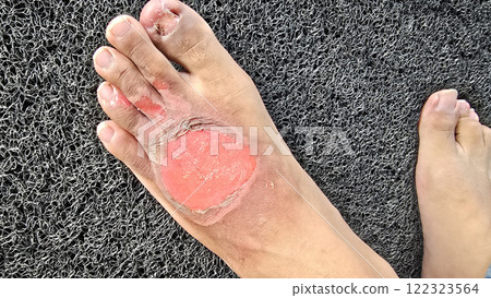 Second degree burns open wound, damage extends beyond the top layer of skin post blisters burst hick, soft, scab-like tissue called fibrinous exudate may develop over the wound Second degree burns open wound, damage extends beyond the top layer of skin post blisters burst hick, soft, scab-like tissue called fibrinous exudate may develop over the wound 122323564