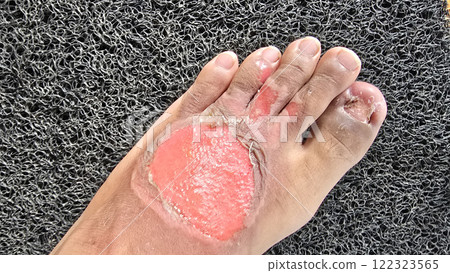Second degree burns open wound, damage extends beyond the top layer of skin post blisters burst hick, soft, scab-like tissue called fibrinous exudate may develop over the wound Second degree burns open wound, damage extends beyond the top layer of skin post blisters burst hick, soft, scab-like tissue called fibrinous exudate may develop over the wound 122323565