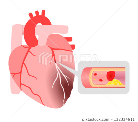 Illustration of a heart with myocardial infarction and a blood clot 122324611