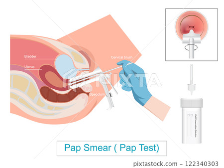 Pap Test ( Pap Smear ) Cervical Cancer Screening. Pap Test ( Pap Smear ) Cervical Cancer Screening. 122340303