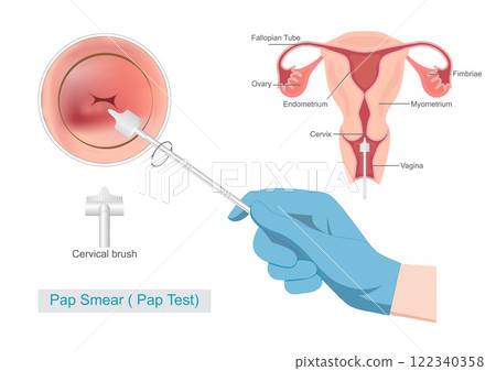 Cervical Cancer Screening by Sampling the endocervix Cervical Cancer Screening by Sampling the endocervix 122340358