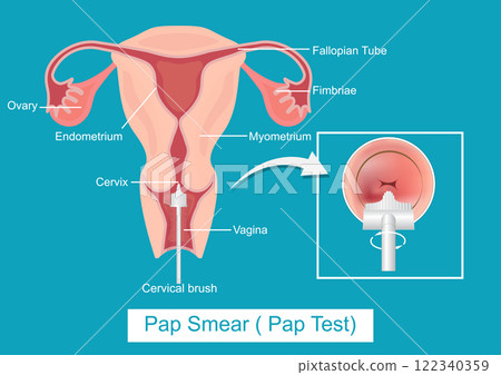 Cervical Cancer Screening or Pap Smear( Pap Test). 122340359