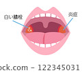 扁桃體炎的說明圖/插圖素材 122345031