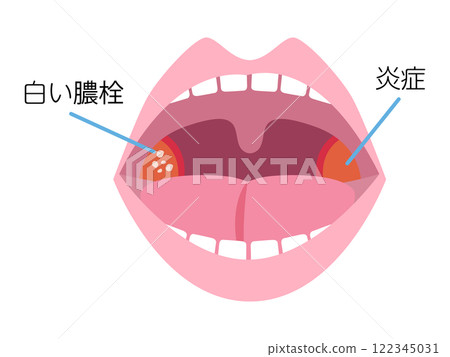 Diagram and illustration of tonsillitis Diagram and illustration of tonsillitis 122345031