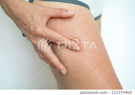 Close up of woman applying Aloe vera gel on her thigh for solving sunburn damaged. 122374408