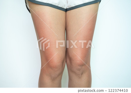 Cropped shot view of woman having sunburn damaged on her thigh. Sunburn is red, painful, damaged skin from being out in the sun for too long. Cropped shot view of woman having sunburn damaged on her thigh. Sunburn is red, painful, damaged skin from being out in the sun for too long. 122374410
