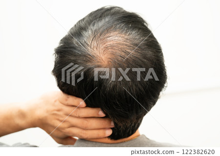 Bald head in man, hair loss treatment health problem. 122382620