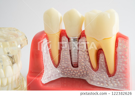 Dental implant, artificial tooth roots into jaw, root canal of dental treatment, gum disease, teeth model for dentist studying about dentistry. 122382626