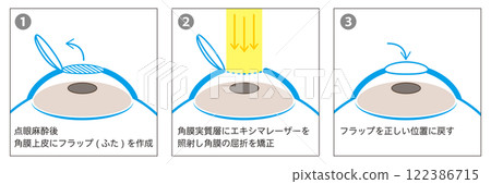 3-step guide to LASIK surgery - Japanese - 122386715