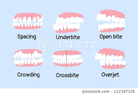 spacing, underbite, open bite, crowding, crossbite, overjet list of orthodontic dental problem spacing, underbite, open bite, crowding, crossbite, overjet list of orthodontic dental problem 122397326