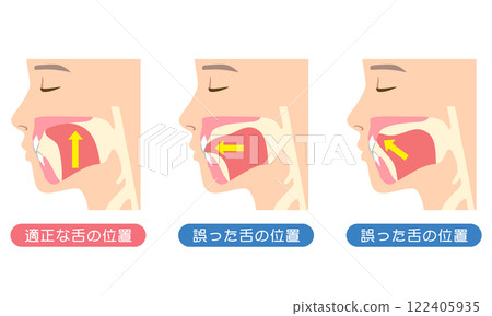 Proper and incorrect tongue position - Mewing 122405935