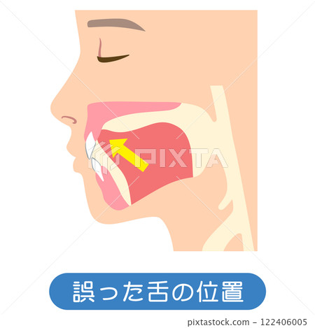 Incorrect tongue position: Lowered tongue position 122406005