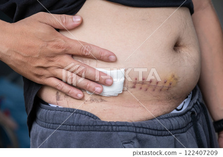 Cropped shot view of patient touching his belly after Appendectomy surgery. 122407209