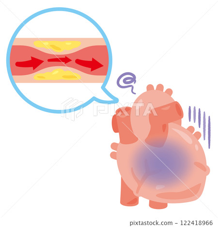 心絞痛的心臟插圖 122418966