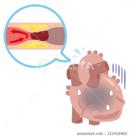Illustration of a heart with clogged blood vessels causing a stroke Illustration of a heart with clogged blood vessels causing a stroke 122418968