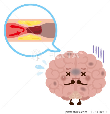 Brain character with clogged blood vessels causing cerebral infarction 122418995