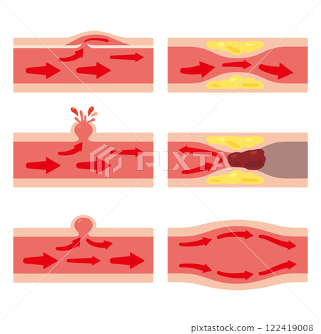 各種條件下的血管插圖集 1 各種條件下的血管插圖集 1 122419008
