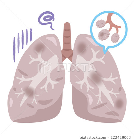 Illustration of lungs with dirty bronchi and alveoli 122419063