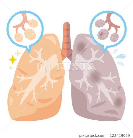 Illustration of half a clean lung and half a dirty lung 122419069