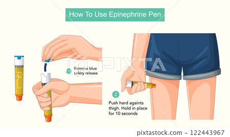 Guide to Using an Epinephrine Pen Guide to Using an Epinephrine Pen 122443967