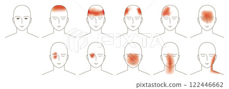 Illustration of the head from the front, showing where the headache occurs. 122446662