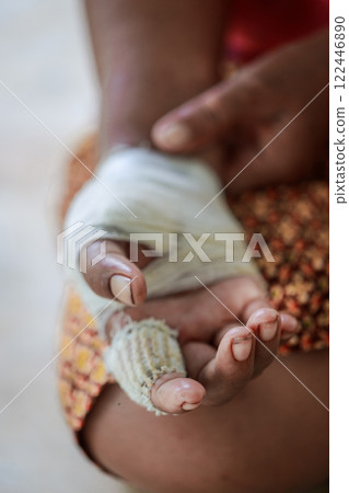 Hand of woman injured and bandaged 122446890