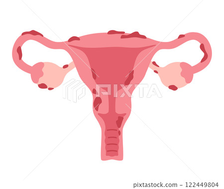Uterus with endometriosis illustration in flat style. Vector illustration 122449804