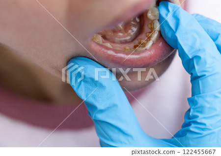 An appointment with a dentist for dental cleaning. Closeup. An appointment with a dentist for dental cleaning. Closeup. 122455667