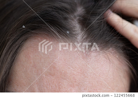 The woman found dandruff on her head. Closeup dandruff flakes on the scalp. The woman found dandruff on her head. Closeup dandruff flakes on the scalp. 122455668