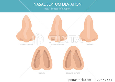 Nose Deviated Septum. Nasal diseases. Medical infographic design Nose Deviated Septum. Nasal diseases. Medical infographic design 122457355