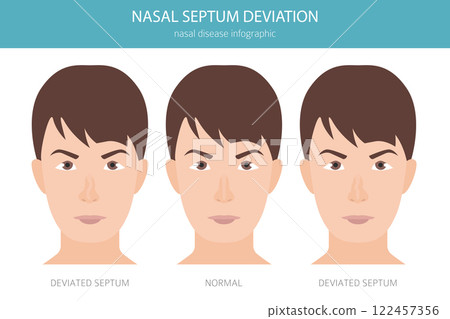 Nose Deviated Septum. Nasal diseases. Medical infographic design Nose Deviated Septum. Nasal diseases. Medical infographic design 122457356