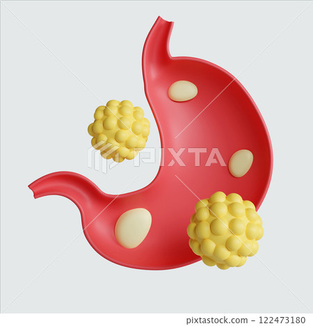 3D render illustration of a stylized stomach with yellow polyp formations. 122473180