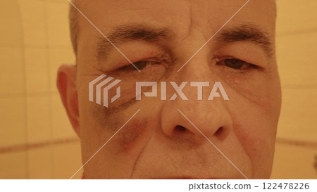 The face of a man with a black eye. Bruise on the face of an elderly man. Concept of aggression, violence, cruelty and domestic violence. Close-up 122478226
