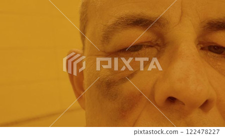 The face of a man with a black eye. Bruise on the face of an elderly man. Concept of aggression, violence, cruelty and domestic violence 122478227
