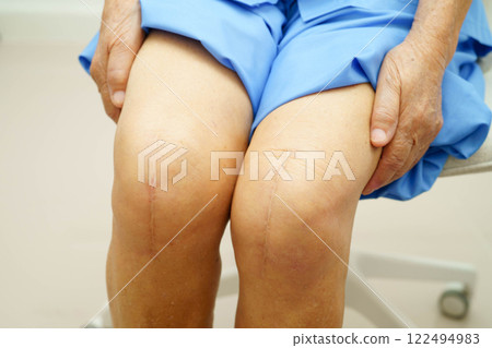 Asian elderly woman patient with scar knee replacement surgery in hospital. Asian elderly woman patient with scar knee replacement surgery in hospital. 122494983