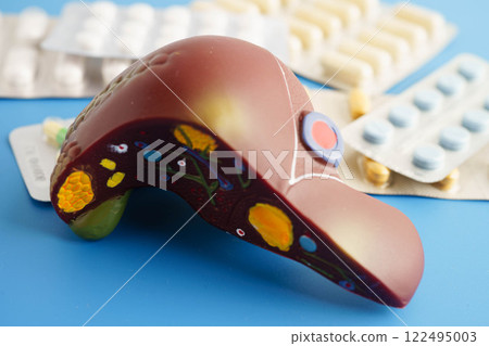 Liver model with pill drug treatment, Cirrhosis, Liver cancer, fatty liver. 122495003