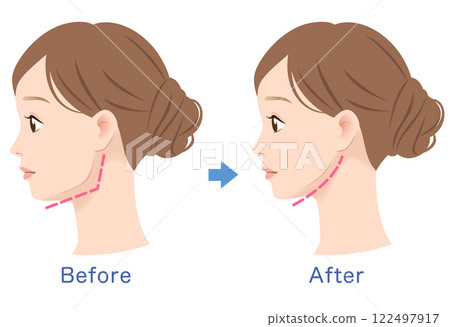 Profile of a woman with a prominent jawline: before and after Profile of a woman with a prominent jawline: before and after 122497917