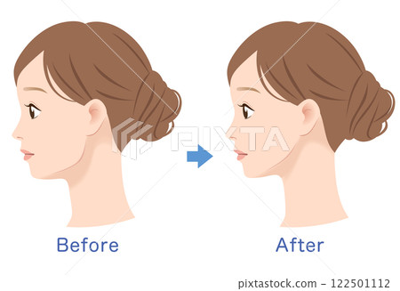 Profile of a woman with a prominent jawline: before and after 122501112