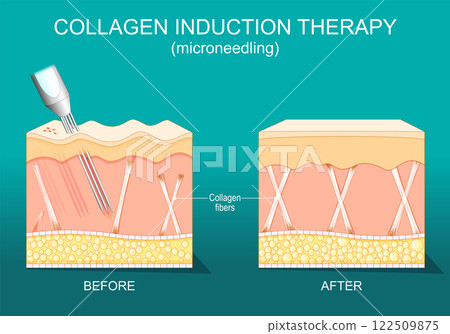 Collagen induction therapy. Skin and Collagen fibers before and after Microneedling procedure. 122509875