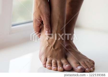 Woman gently touching her foot with large swollen veins.  122539366