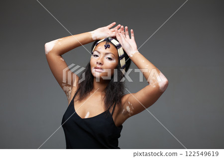 Confident female fashion model with vitiligo Confident female fashion model with vitiligo 122549619
