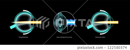 LASIK farsightedness surgery 122580374