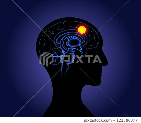 Brain cancer poster Brain cancer poster 122580377