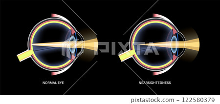 Normal eye and nearsightedness 122580379
