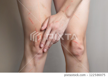 Scratches on the woman's body. Scratches on your hands, on your feet. Scratches from cat, dog, beast, falls cropped nude close up photo Scratches on the woman's body. Scratches on your hands, on your feet. Scratches from cat, dog, beast, falls cropped nude close up photo 122586075