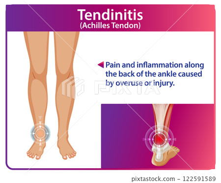 Achilles Tendonitis Medical Illustration Achilles Tendonitis Medical Illustration 122591589